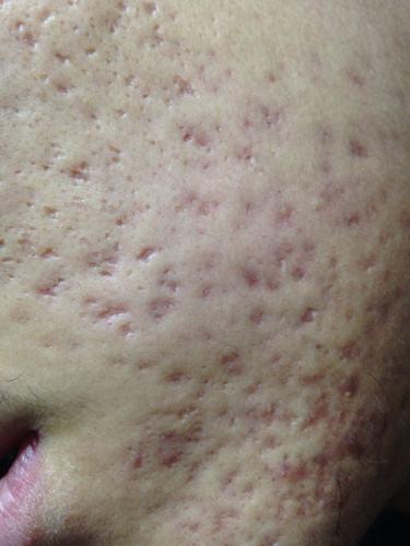 青春“悔恨”痘印该如何解决？详细解决方法全解答，不再“作死”