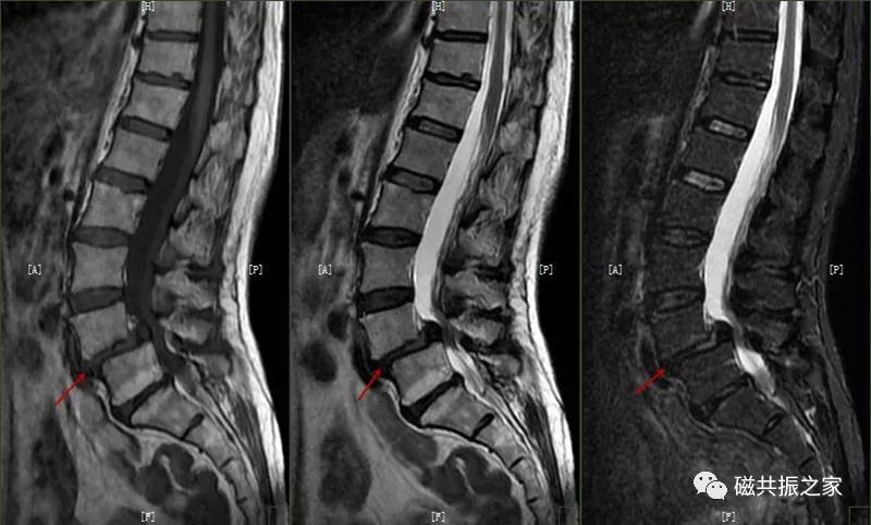 腰椎有哪些病变,腰椎病变有几种