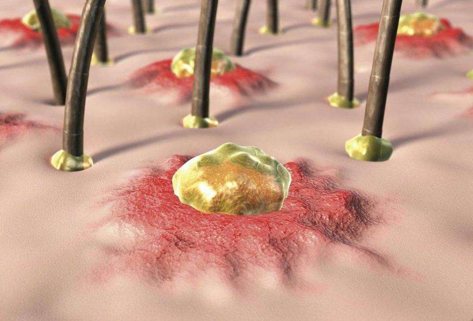 暗疮消炎能消掉么,大暗疮用什么消炎最快