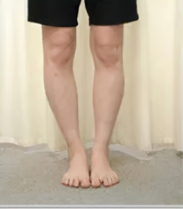 老年o型腿最快变直的方法,o型腿适合穿什么类型鞋