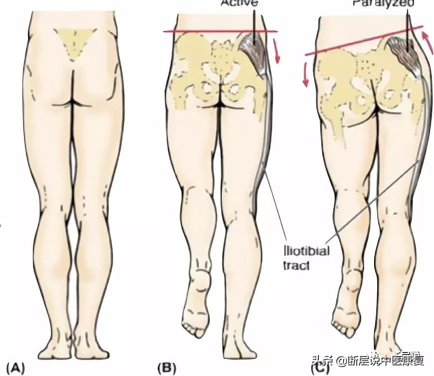 腰痛、膝痛、髋关节失稳？都是臀中肌无力惹的祸