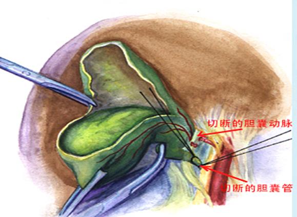 腹腔镜微创手术是做什么的,腹腔镜微创手术治疗啥的
