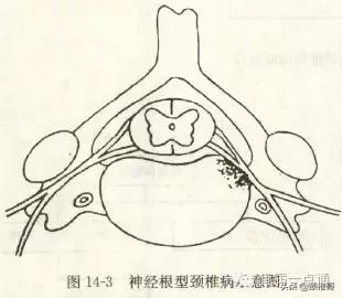 神经根型颈椎病，仅1%的患者需要手术，确定不是你？