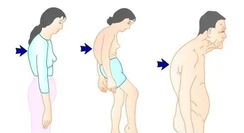 脊柱无侧弯但两侧腰线不对称,两边腰线弧度不一样是脊柱侧弯吗