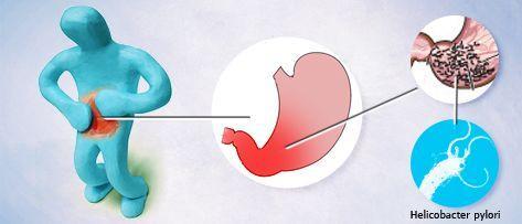 乙肝容易导致胃病吗,乙肝和胃病有什么关系