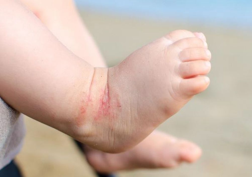 破皮结痂，又到湿疹高发季！这样护理更有效果