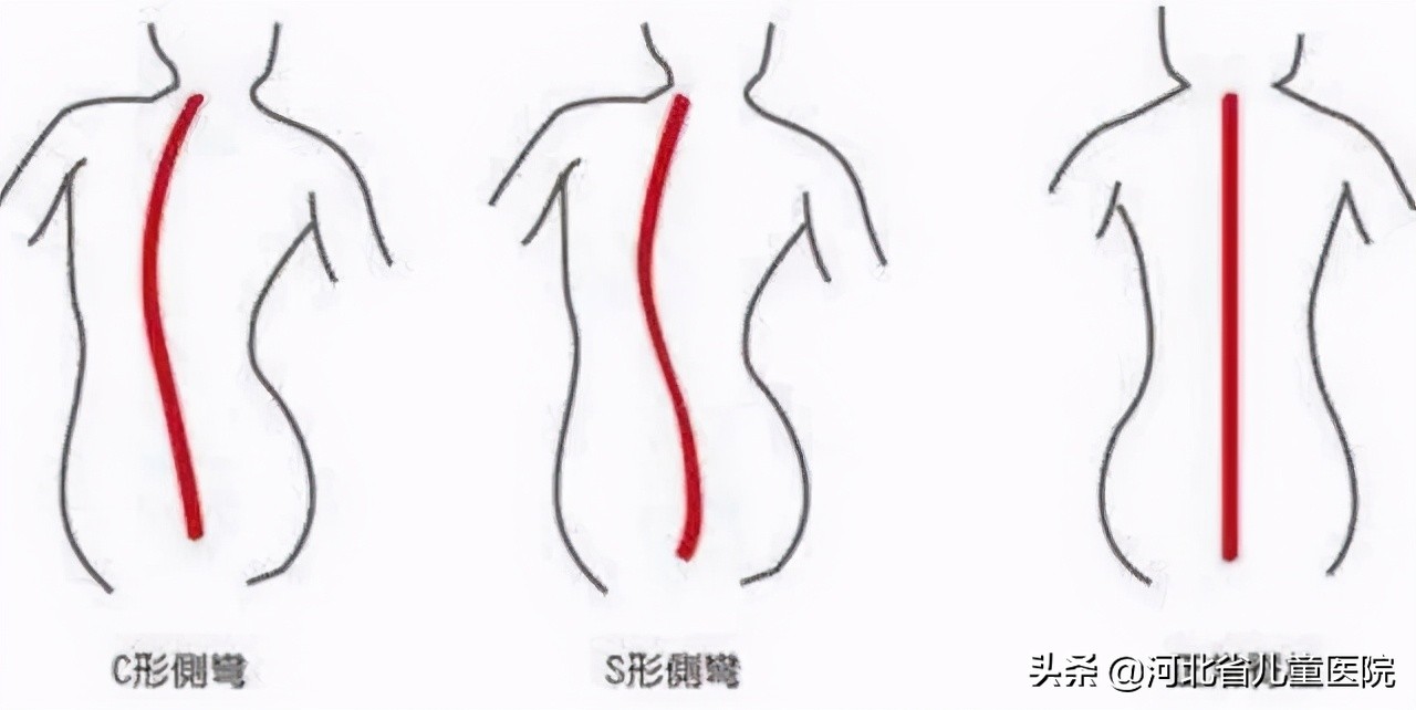 为河北省儿童医院点赞！一台手术让孩子长高5厘米！