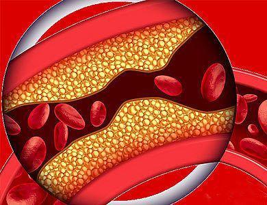 有高血压但测量时候不高吃不吃药,血压达到180就是确诊高血压了吗