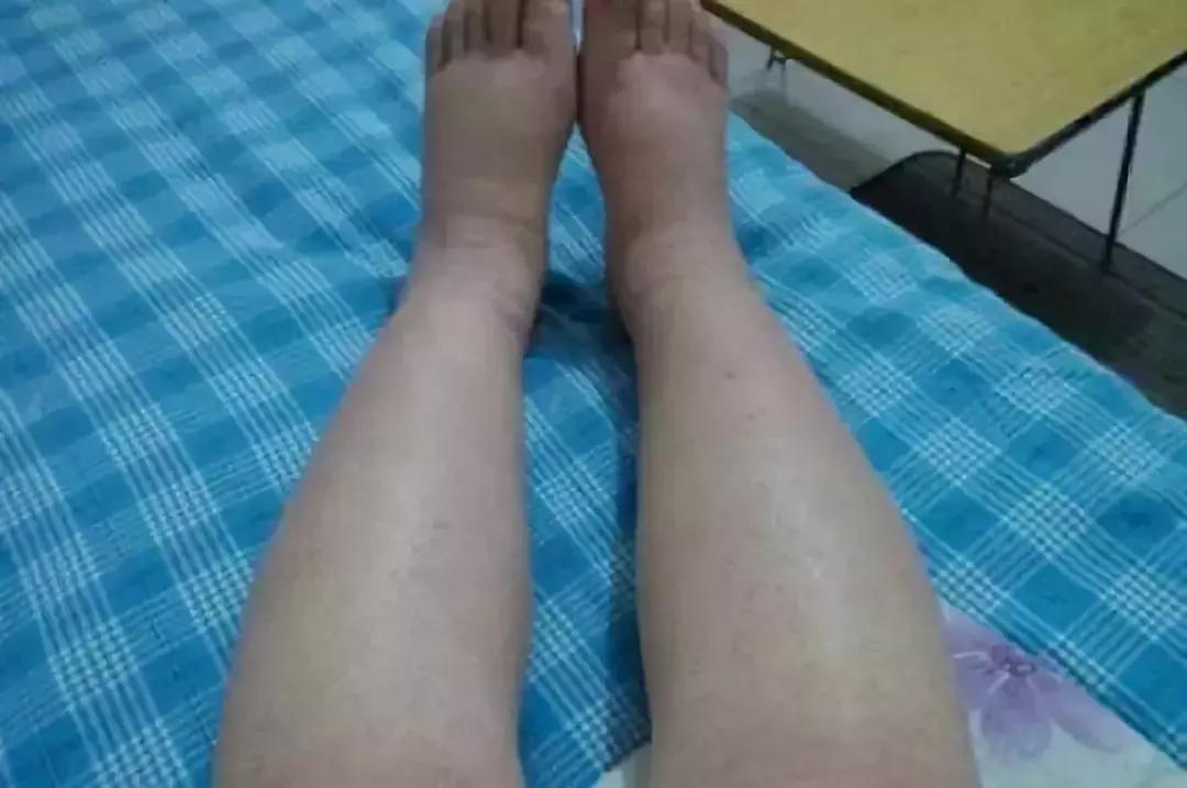 肝硬化早期常见的七种症状都没有,怎样确诊肝硬化已经到了晚期