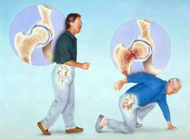 髋部骨折危害大老年人摔伤要重视,老人胯骨骨折死亡率