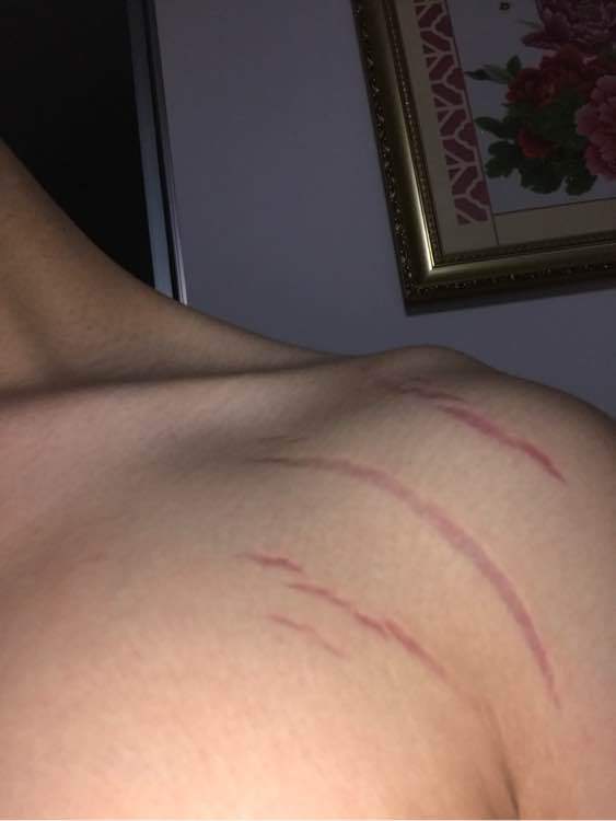 健身之后皮肤出现纹路怎么回事,健身皮肤出现撕裂纹怎么办