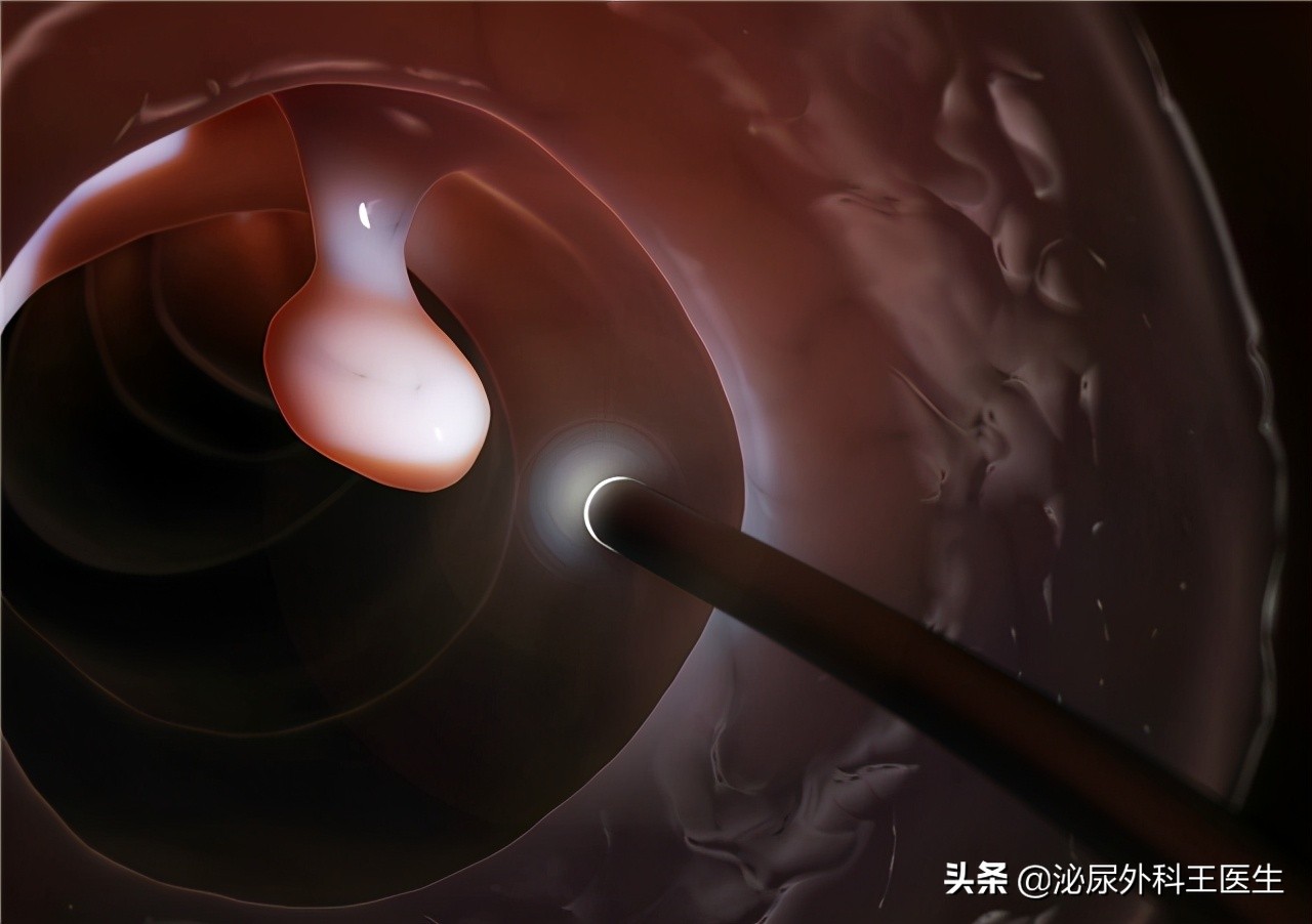 男子每天大便两三次结果是肠癌,大便带血的肠癌怎么判断早期晚期