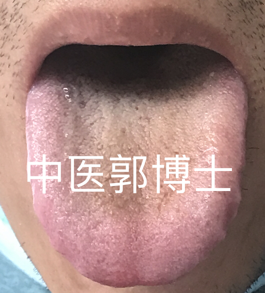 舌质红苔腻微黄中医辨证,舌苔暗红中后部苔厚中医辨证