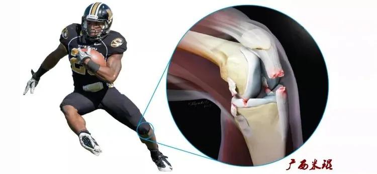 膝盖扭伤前交叉韧带损伤可以热敷,前交叉韧带扭伤最快自愈方法