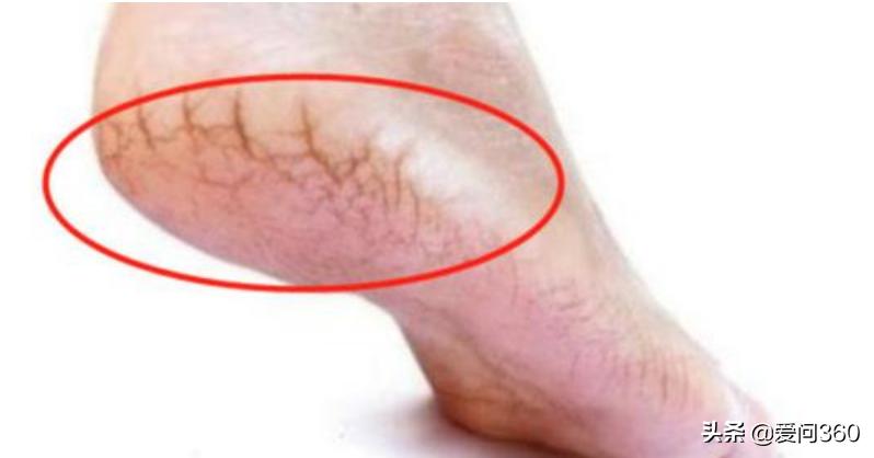 中老年人脚后跟开裂，大多是这些原因造成的，5个方法可改善