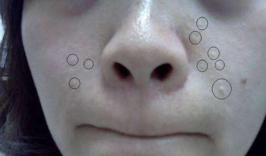 脸上有闭合性粉刺怎么去除,满脸闭合性粉刺痘痘怎么去除