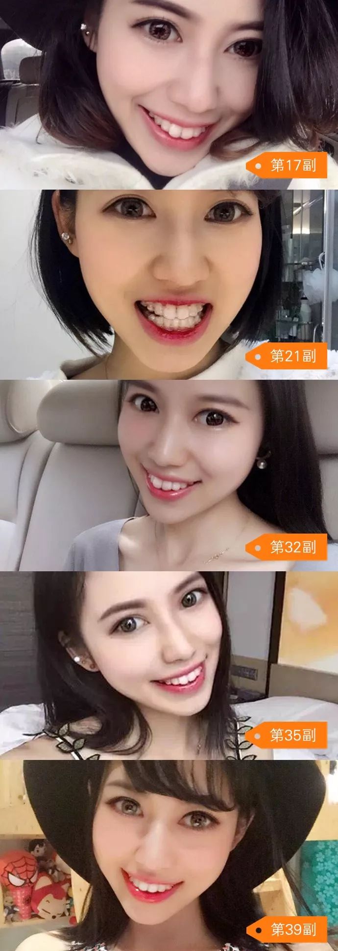 龅牙矫正前后对比照片,龅牙修复效果图