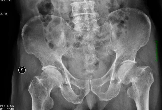 骨质疏松骨折髋关节置换手术,粗隆间骨折需要做髋关节置换吗