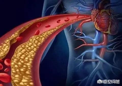 高脂血症饮食原则,高脂血症的饮食治疗方法有哪些