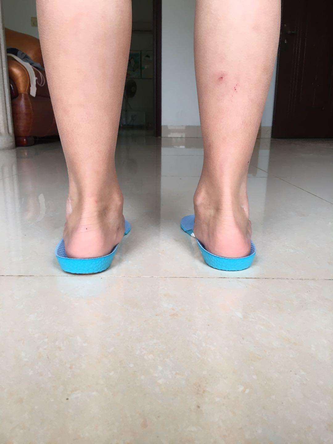 8岁儿童扁平足的最佳治疗方法,扁平足小朋友要矫正不