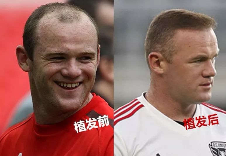 贝克汉姆脱发最新消息,大卫贝克汉姆脱发