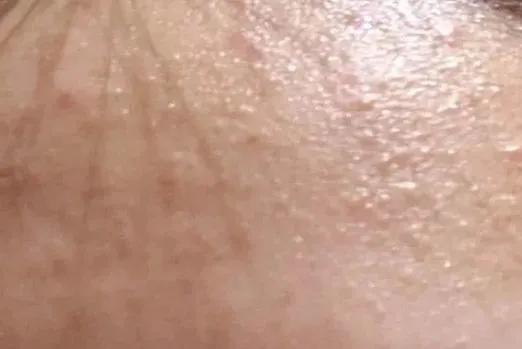 舒善：又油又干长痘还脱皮