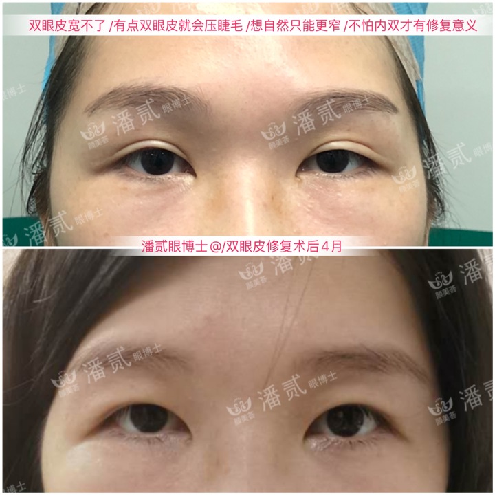割双眼皮眼皮压下来会恢复吗,割双眼皮以后会松弛更快吗
