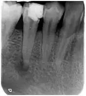 小孩拍牙齿片有危害吗,拍牙片对孩子的影响