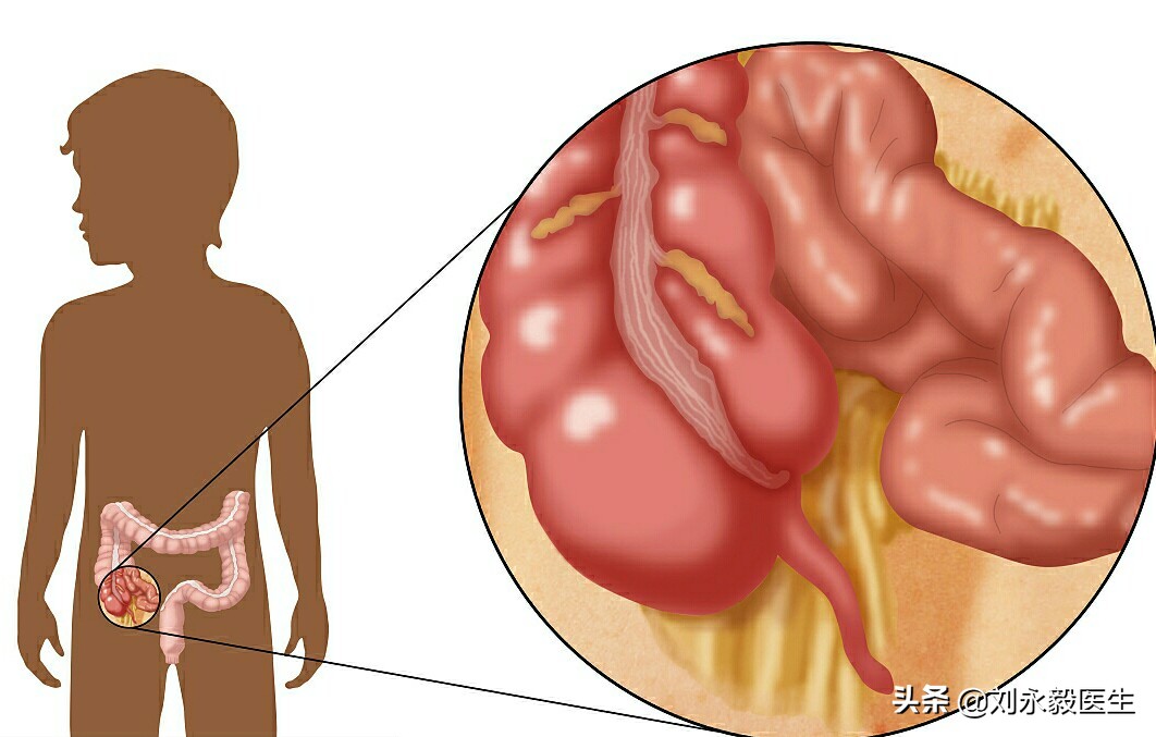 儿童阑尾炎术后饮食注意事项,阑尾炎术后七十天注意点什么