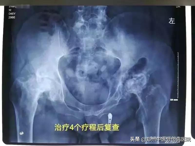 沈阳股骨头坏死患者视频,股骨头坏死沈阳保守治疗