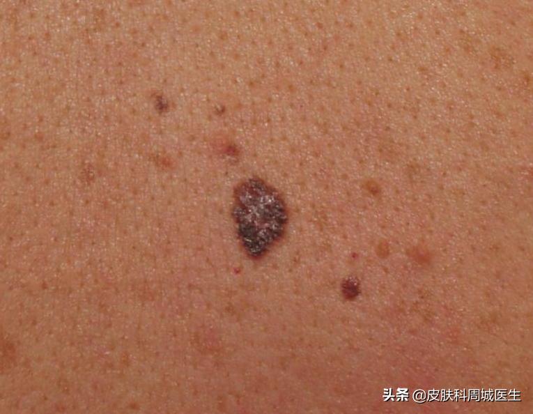 皮肤科什么肿瘤恶性高,皮肤恶性黑色素瘤是癌吗