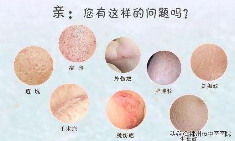 二氧化碳点阵激光真的有用,二氧化碳点阵激光真的有用吗