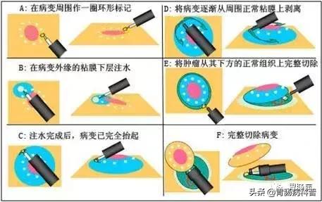 切肠息肉有风险吗,肠息肉为什么大了不能直接切