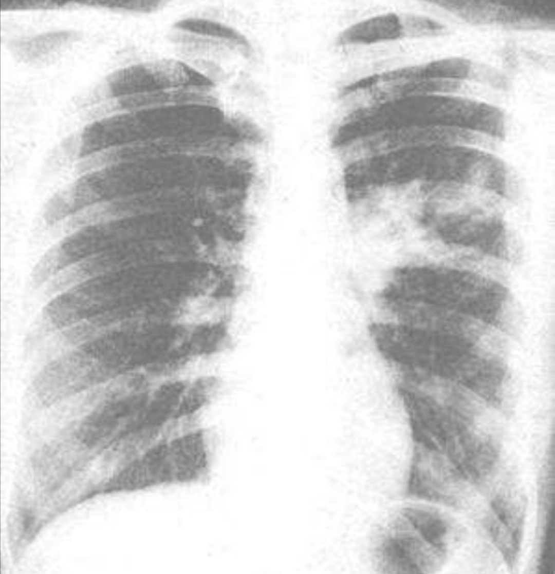 儿童肺炎支原体感染的症状和表现,宝宝肺炎支原体感染最有效的方法