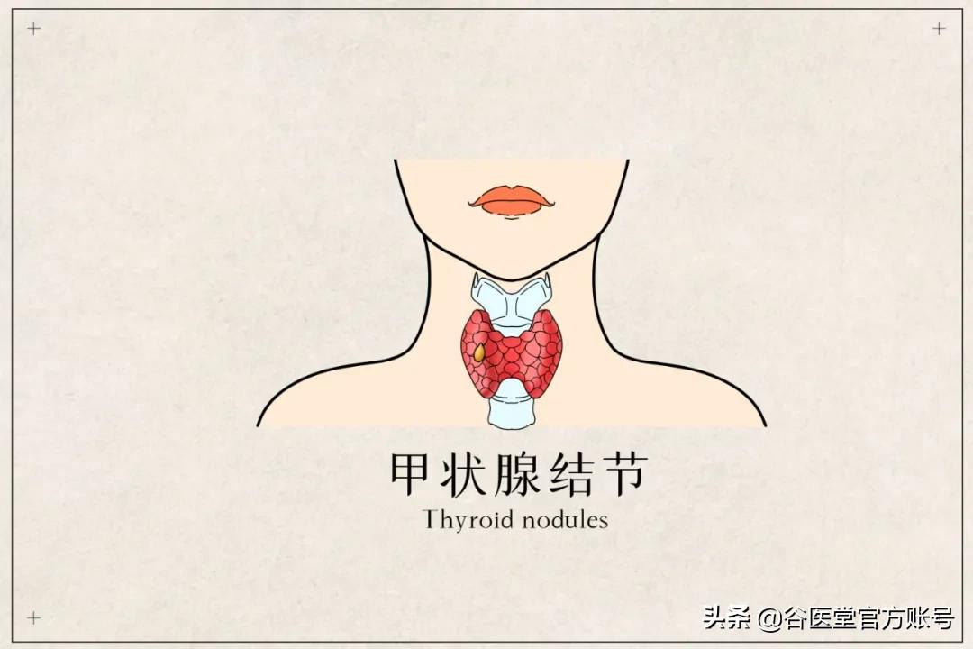 男子甲状腺结节，谷医堂耳鼻喉老中医庞忠红，42天治疗获奇效