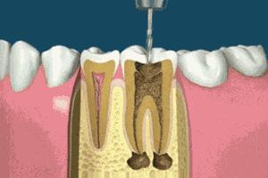 根管和补牙戴全瓷牙冠一共多少钱,为什么要做根管治疗不能直接补牙