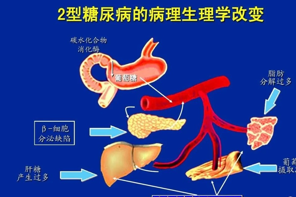 糖尿病一型和二型的区别在哪里,糖尿病1型和2型区别注意事项