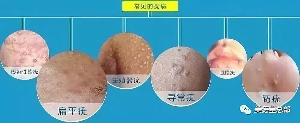 脚底鸡眼和跖疣的区别,挤鸡眼和跖疣的区别