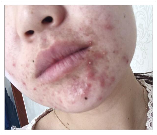 根除脸上螨虫的简单方法,螨虫在脸上如何彻底消除