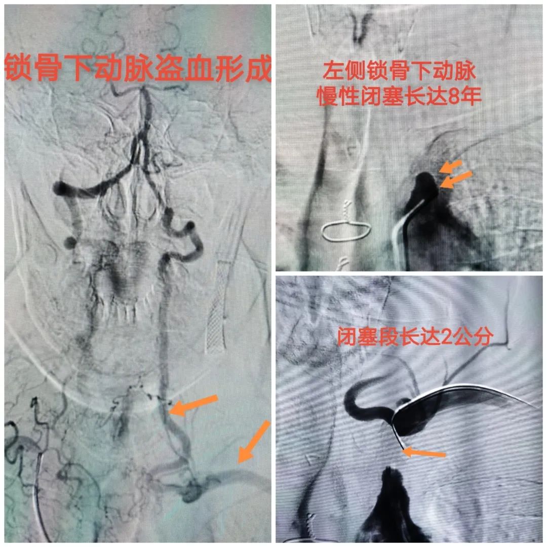 脑卒中发生时自己怎么自救,脑卒中急救黄金1小时