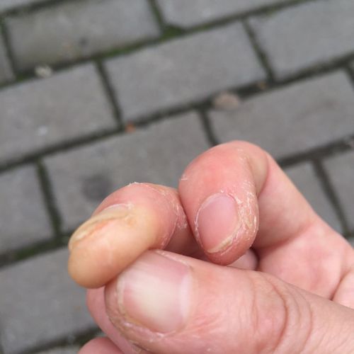 春季手指脱皮是怎么回事,春季儿童手指肚脱皮怎么治