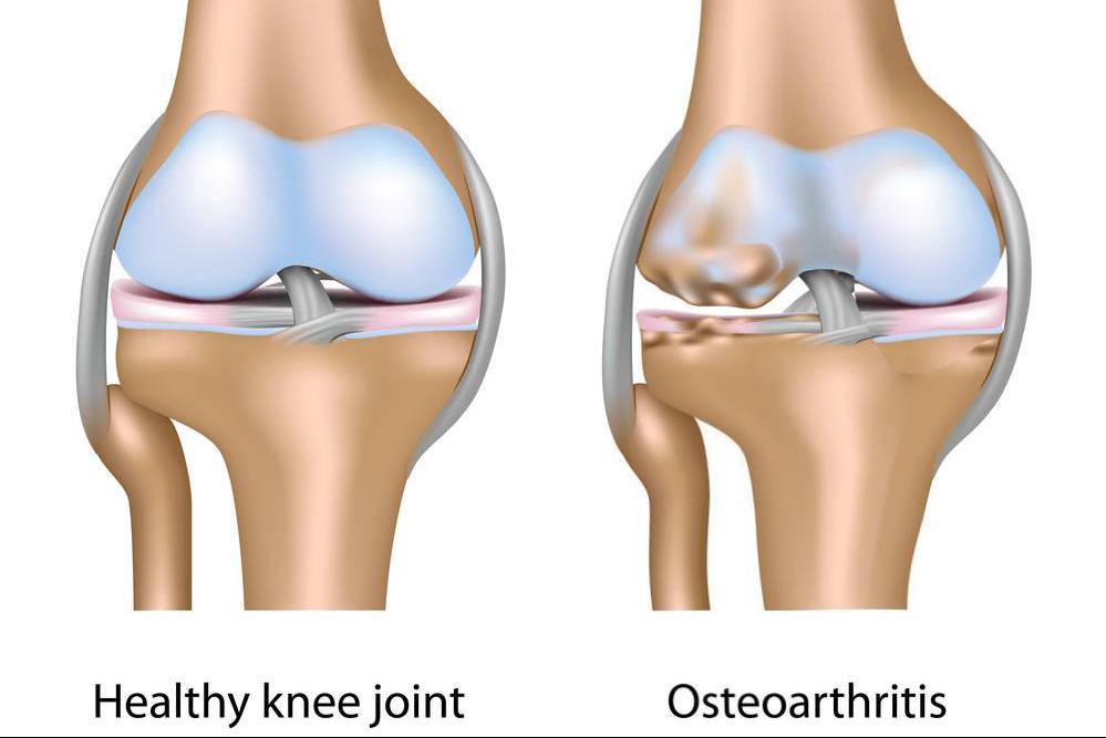 深蹲练习可以治疗膝关节吗,膝关节不好的人能练深蹲吗