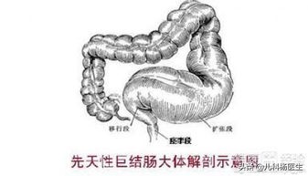 杨医生讲中医治便秘,杨医生科普便秘