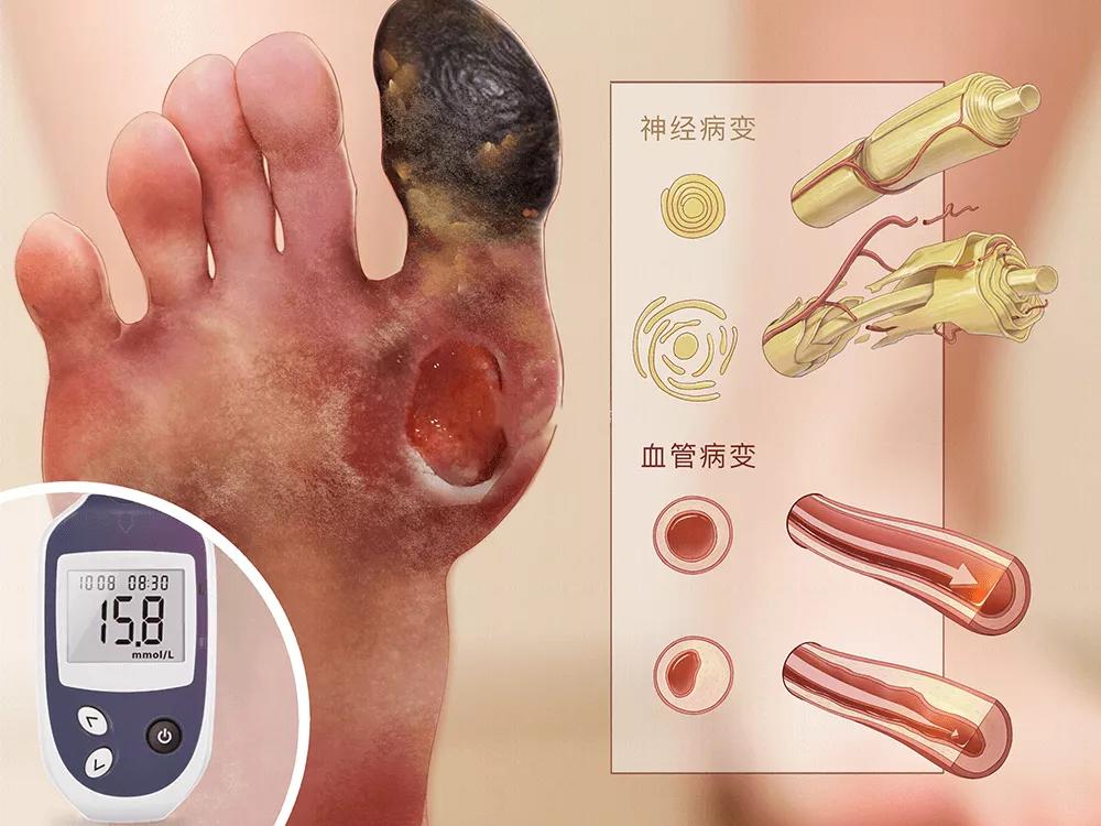 糖尿病足多学科诊治中心,糖尿病足多学科会诊