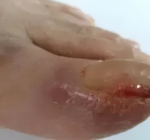 靶向药物导致皮疹的护理,靶向药造成的肌肉损伤能自愈吗