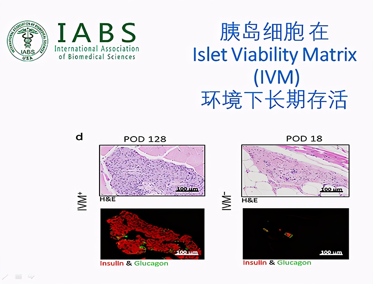 美国批准治愈一型糖尿病疗法,美国治疗1型糖尿病新进展
