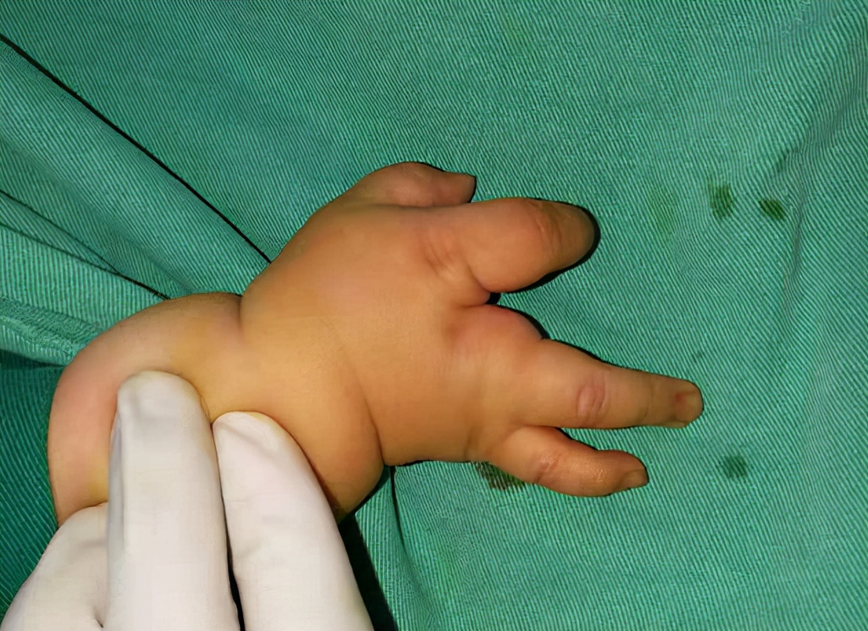 并指畸形免植皮案例,并指畸形