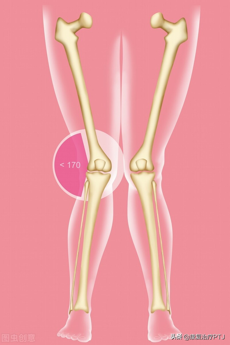 下肢力线异常的后果,下肢力线异常的临床表现