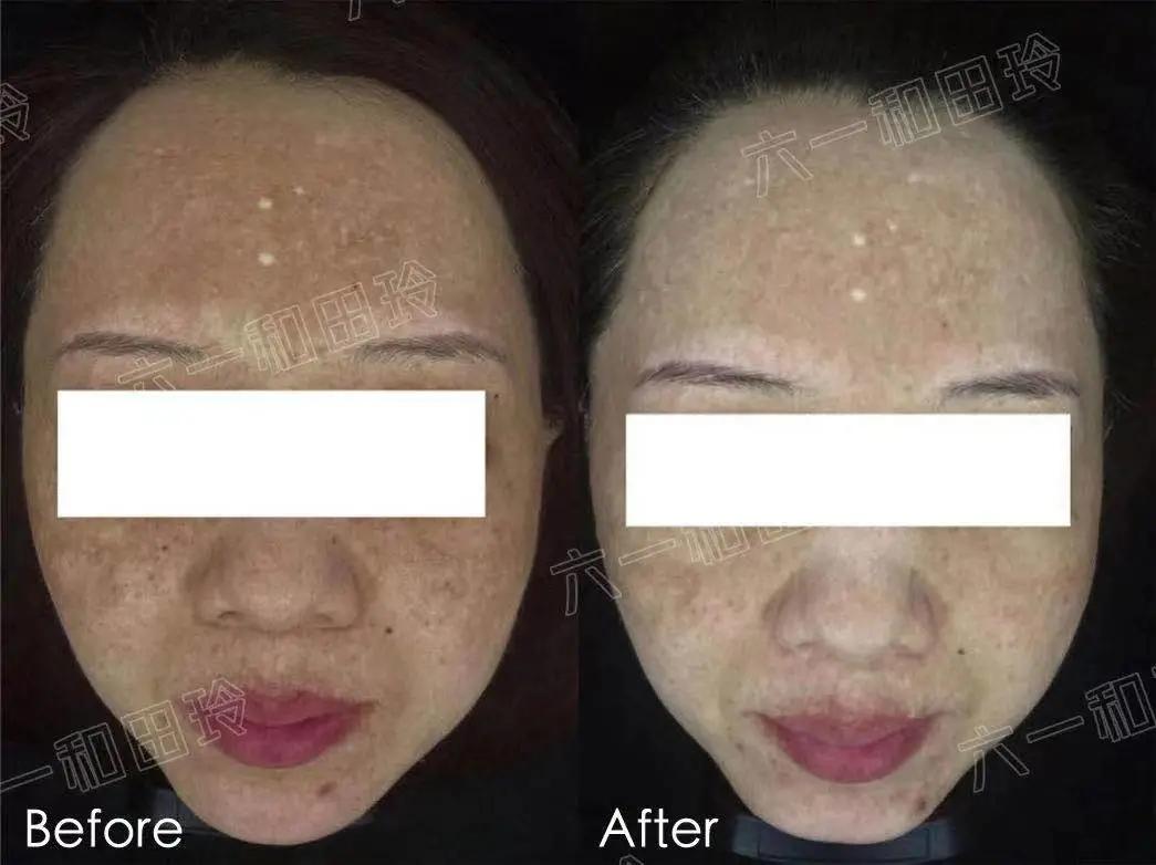 医美刷酸后爆痘期要多久,痘痘肌医美刷酸能好吗