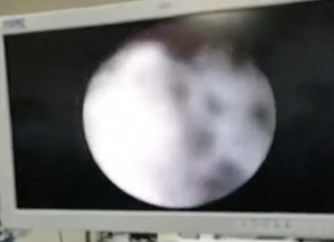 2岁女宝流少量鼻血有腥味,儿童出现隐性出血以后需要查什么